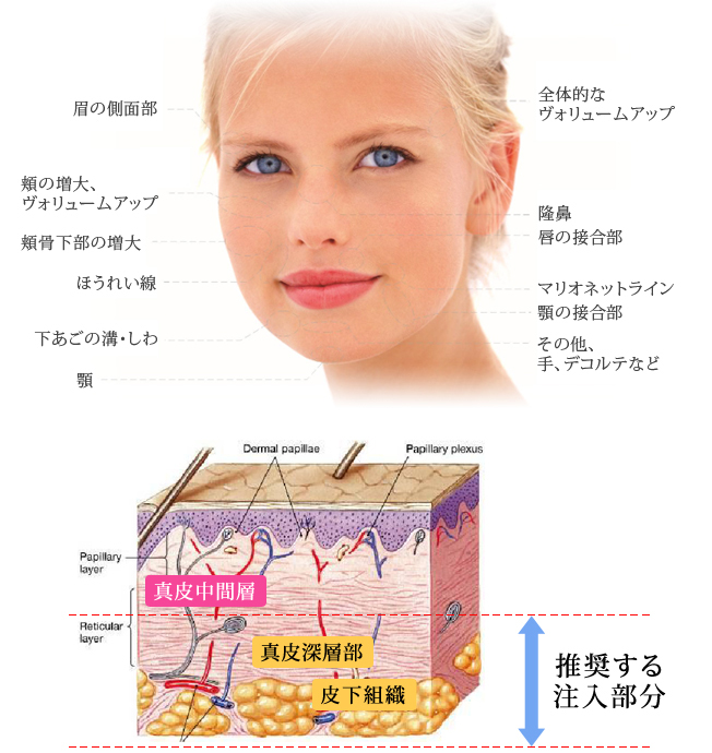 エランセ注入部位