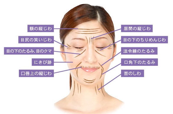 W-PRP注入箇所・量の目安