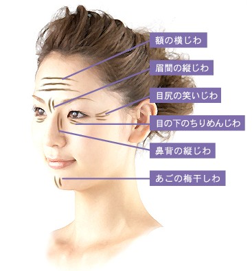 ボツリヌス菌注入箇所