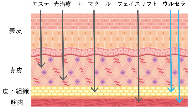 ウルセラの効果